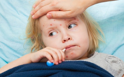 child-with-measles