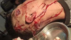 В соцсетях распространяются фотографии раненых во время митинга