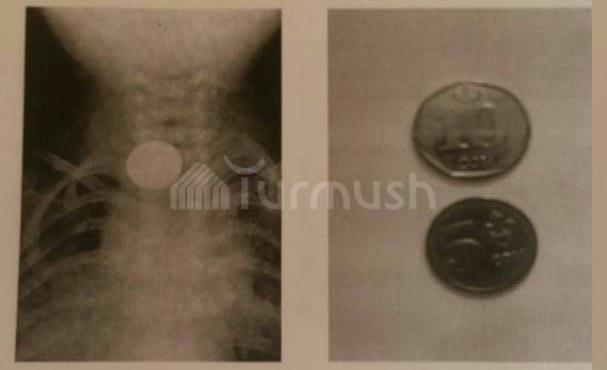 Ребенок проглотил монету 5