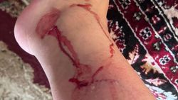В жилмассиве «Щербакова» собаки напали на женщину и покусали ноги. Фото