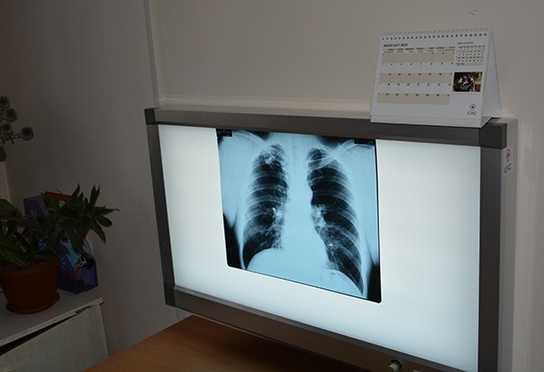All workers examined after confirmation of TB case in Bishkek school, mayor's office says - Vimarsana News