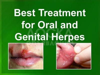 Natural CURE FOR HSV  1&2  +2347059361102 POWERFUL HERBS