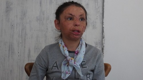 CentralAsia: В России хирург восстановил лицо девочке из Узбекистана после ожогов от взрыва - Vimarsana News