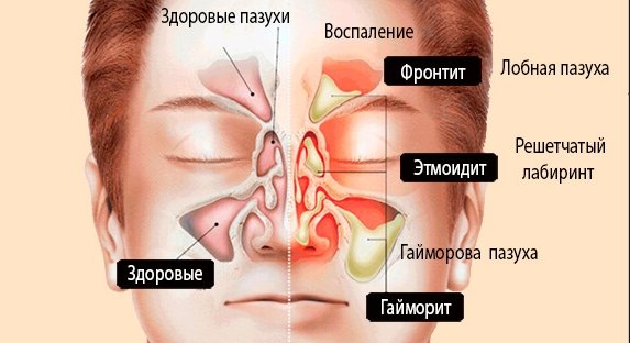 Гайморит - симптомы, причины, лечение и профилактика у взрослых и детей