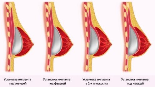 Фото До и После подтяжки груди