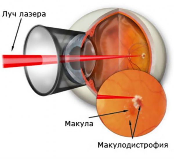 Глаз после лазерной коагуляции сетчатки. Отслойка сетчатки лазеркоагуляция. Панретинальная лазеркоагуляция сетчатки. Барьерная лазеркоагуляция сетчатки. Отслойка сетчатки лазерная коагуляция.