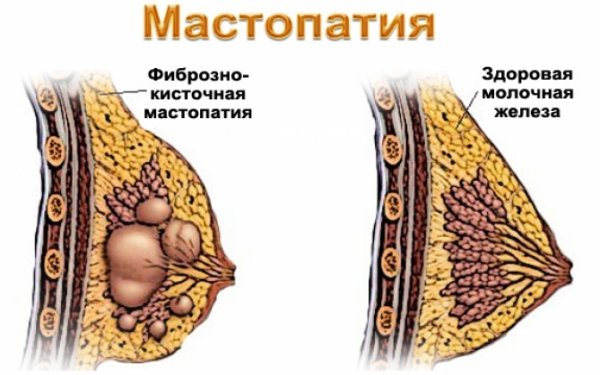 Депрессяшка «маленькие сиськи»