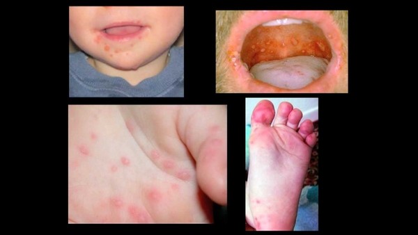 Вирус Коксаки: очередная болезнь грязных рук
